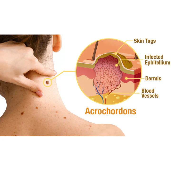 Last Day Of Discount 🔥 TagRecede Bee Venom Treatment Spray